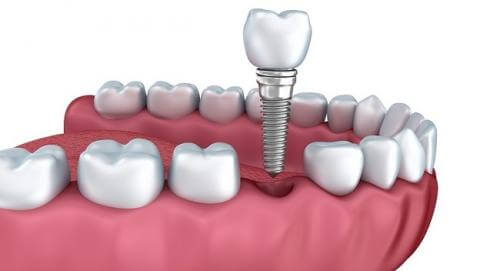 implante-dental-burgos