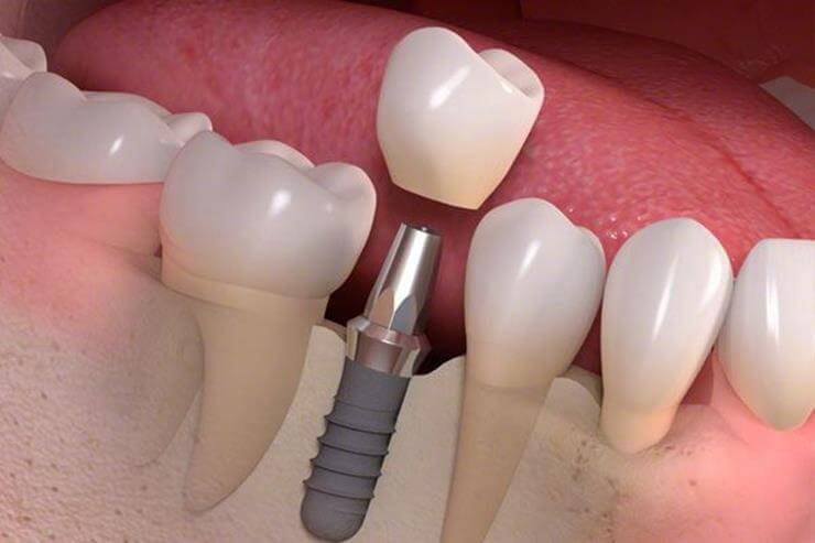 implante-dental-en-burgos