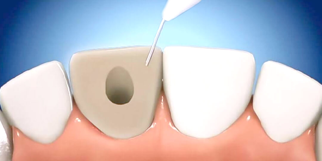 blanqueamiento-dental-interno-clinica-druiz