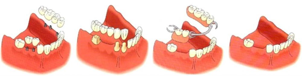 tipos-puentes-dentales