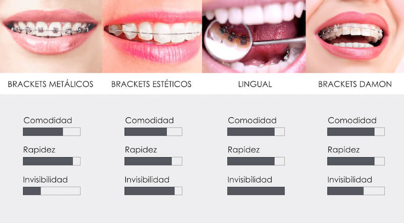 tipos-ortodoncia-brackets-burgos