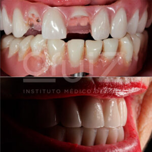 Caso de implantes dentales - Clínica Dental Druiz (Burgos)